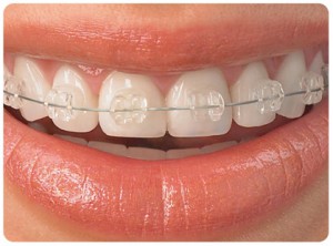 ortodoncia con zafiro