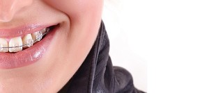 Clinica-dental-en-Las-Rozas-explica-las-modalidades-de-ortodoncia