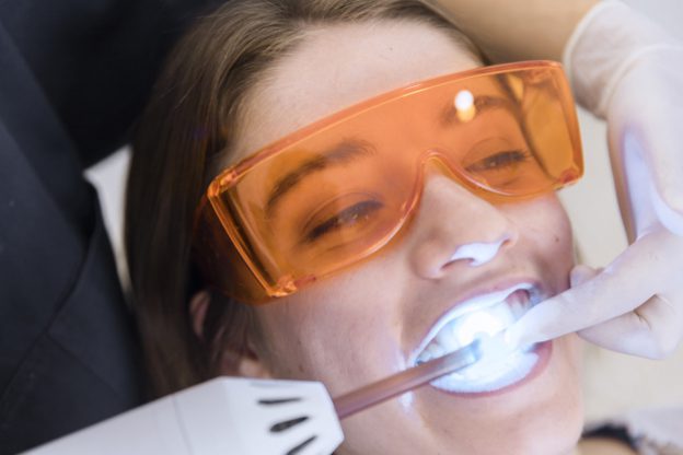 Blanqueamiento dental. Estetica dental